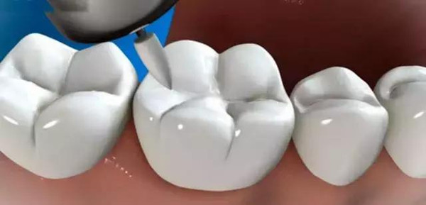 窝沟封闭