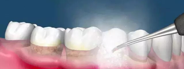 洗牙